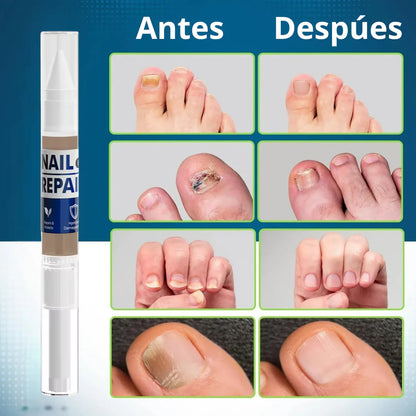 LAPIZ HONGOS – Tratamiento localizado, acción antifúngica y recuperación visible en uñas y piel