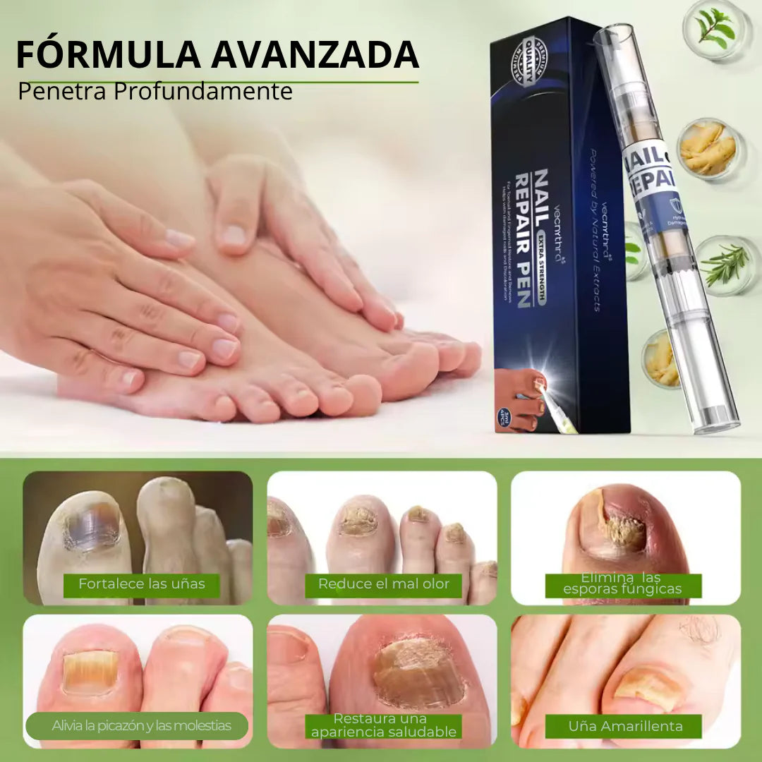 LAPIZ HONGOS – Tratamiento localizado, acción antifúngica y recuperación visible en uñas y piel