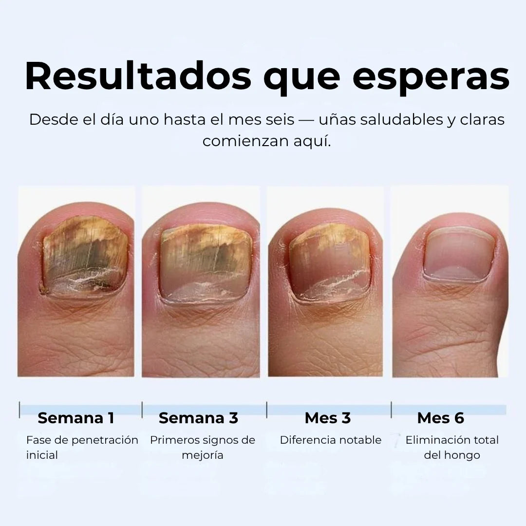 LAPIZ HONGOS – Tratamiento localizado, acción antifúngica y recuperación visible en uñas y piel