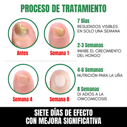 7 DAYS NAIL FUNGUS TREATMENT — Elimina el hongo, regenera y fortalece tus uñas desde la raíz