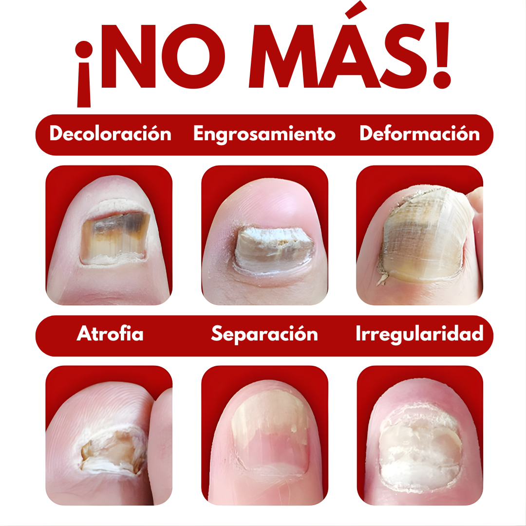 7 DAYS NAIL FUNGUS TREATMENT — Elimina el hongo, regenera y fortalece tus uñas desde la raíz