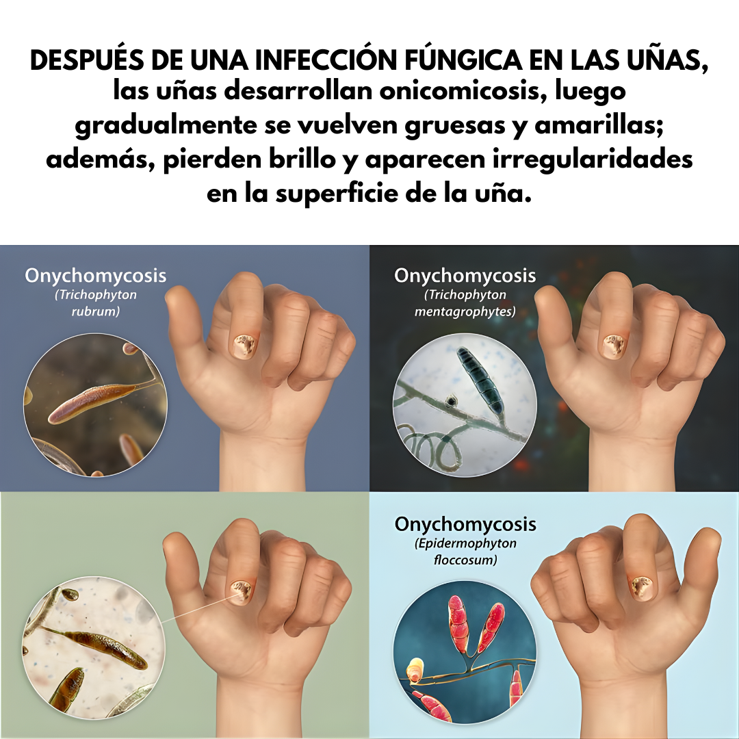 TRATAMIENTO DE HONGOS – Elimina el hongo, regenera y fortalece tus uñas desde la raíz