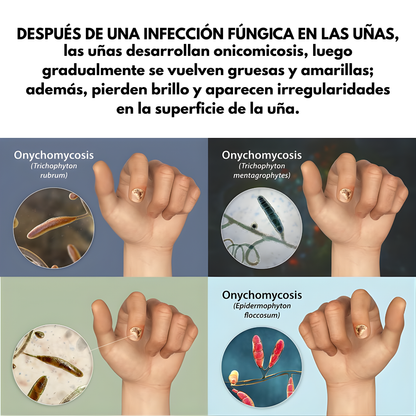 QUITA HONGOS UÑAS – Elimina el hongo, regenera y fortalece tus uñas desde la raíz