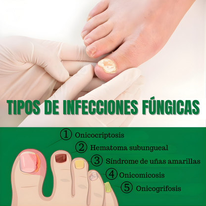 TRATAMIENTO DE HONGOS – Elimina el hongo, regenera y fortalece tus uñas desde la raíz
