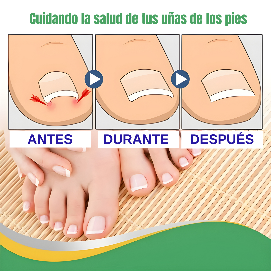 CURA PARA LOS HONGOS – Corrige, protege y recupera la forma natural de tus uñas