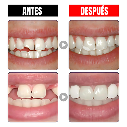 Dientes Postizos - La solución rápida y segura para emergencias dentales.