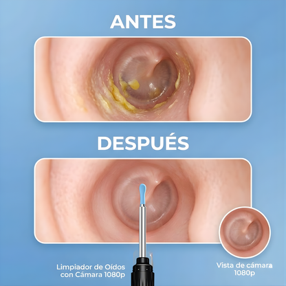LIMPIADOR DE OÍDOS CON CÁMARA – Limpieza visual, control total y cuidado seguro para tus oídos
